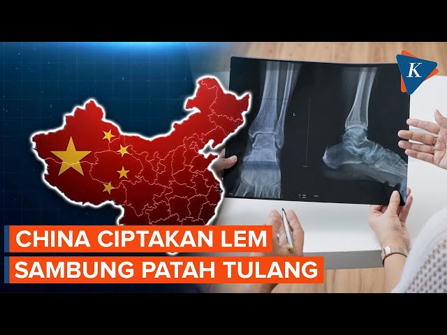 China Kembangkan Lem yang Bisa Rekatkan Tulang Patah dalam 3 Menit